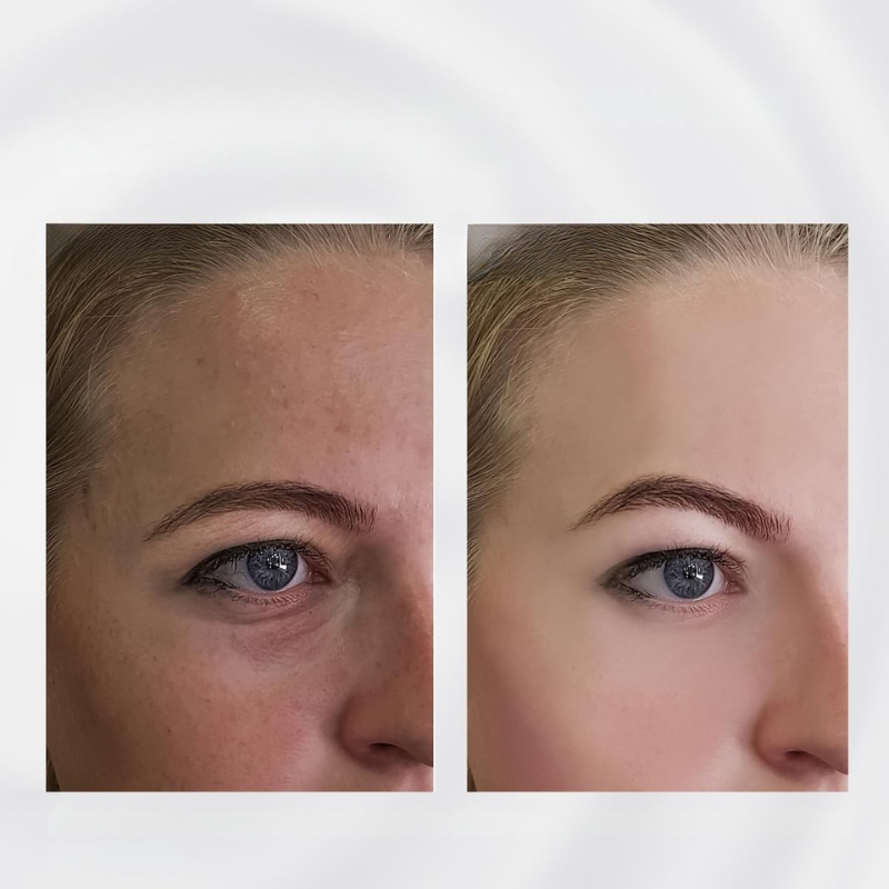 RadiantRoll - Stainless Steel Skin Tightening Tool