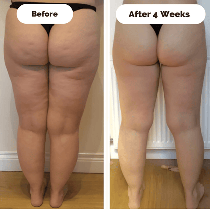 SKINLIFT – Skin-firming massage device against cellulite 3