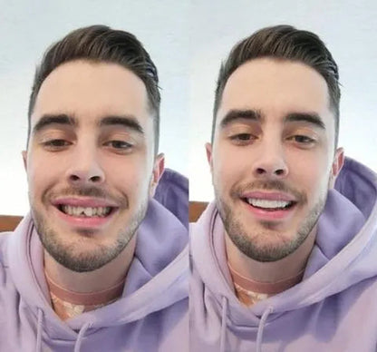 Vivolux | On Smile Veneers (upper and lower jaw included) 2